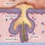 Acne Problem Solutions