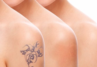 Removing Unwanted Tattoos