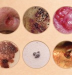 The Importance of Early Detection of Melanoma