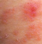 Recognizing Skin Disorders