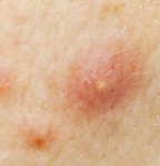 Acne FAQ’s