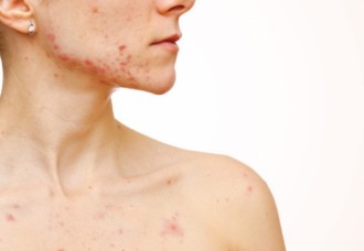 Acne on the Body