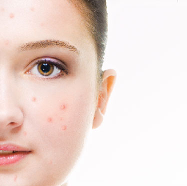 acne_resources_dermascope_com