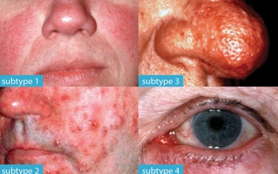 10 Things About... Rosacea