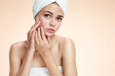 Gone for Good: Treatment  and Prevention of Acne Scarring
