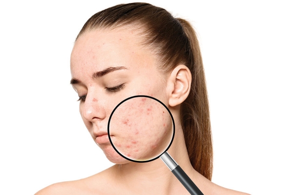 Trouble in Therapy: Rising Issues in Dermatological Acne Treatment
