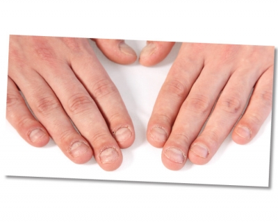 What’s your recipe for treating nails that have been damaged by acrylics?