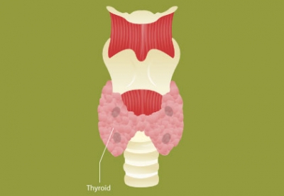 Obesity and Thyroid Cancer