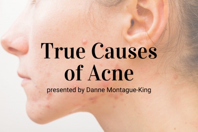 Webinar: True Causes of Acne