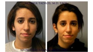 Teenage patient from NJ shares her rhinoplasty surgery experience
