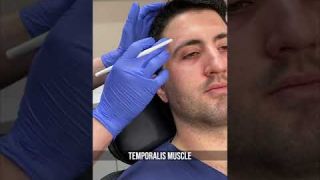 NYC Botox for Men | UES Male Botox Injections | Forehead Wrinkle Reduction | Dr. Gary Linkov