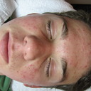 Before and After - Noninflamed Acne