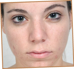 Acne-and-Teenage-Skin