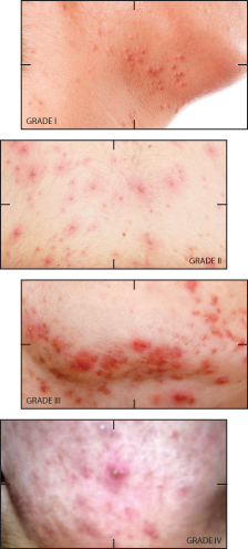 grade-of-acne