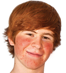 boy-acne