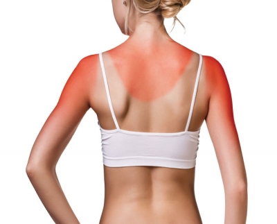 Sunburn Treatment Protocol