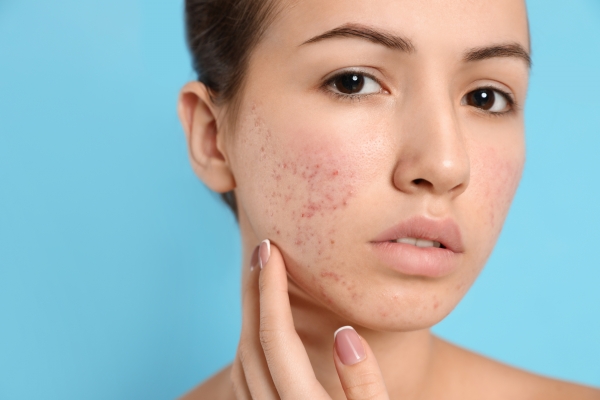 Teen Troubles: Real World Advice for Treating Teenage Acne
