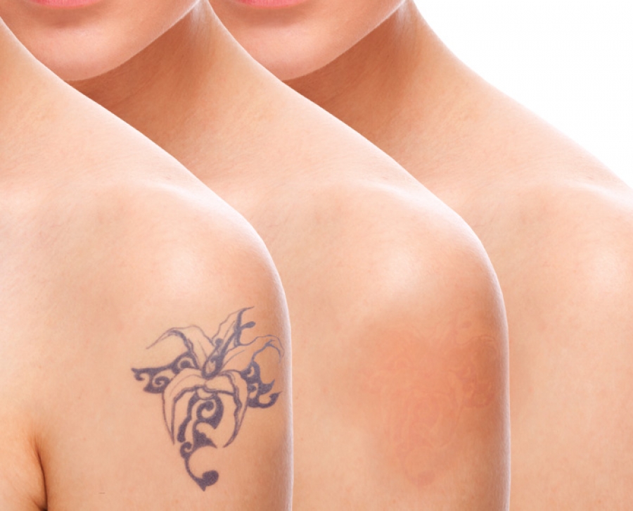 Tattoo Removal services - Sheryne Skin