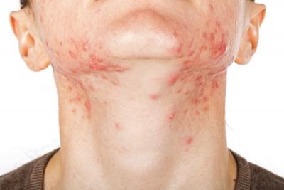 What Really Causes Acne? Alternative Views and Holistic Solutions