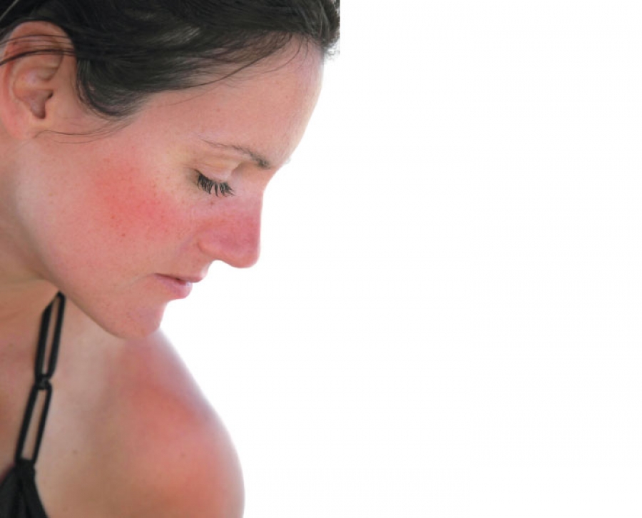 Soothing Sunburns with an Integrative Approach