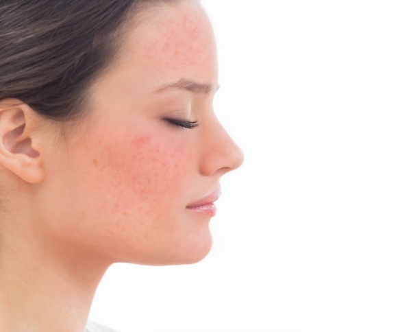 10 Things About Rosacea