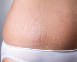 The Efficacy of  Stretch Mark Solutions