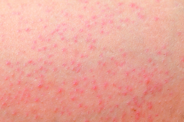 Educating Clients on Folliculitis