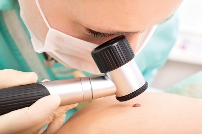 Unmasking Melanoma: New Tools and the Role of Early Detection