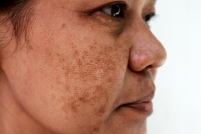 Pigmentation Protocol: From Treatment to Prevention &amp;amp; Everything In-Between