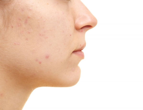 Acne Scarring: 4 Therapies for Improvement