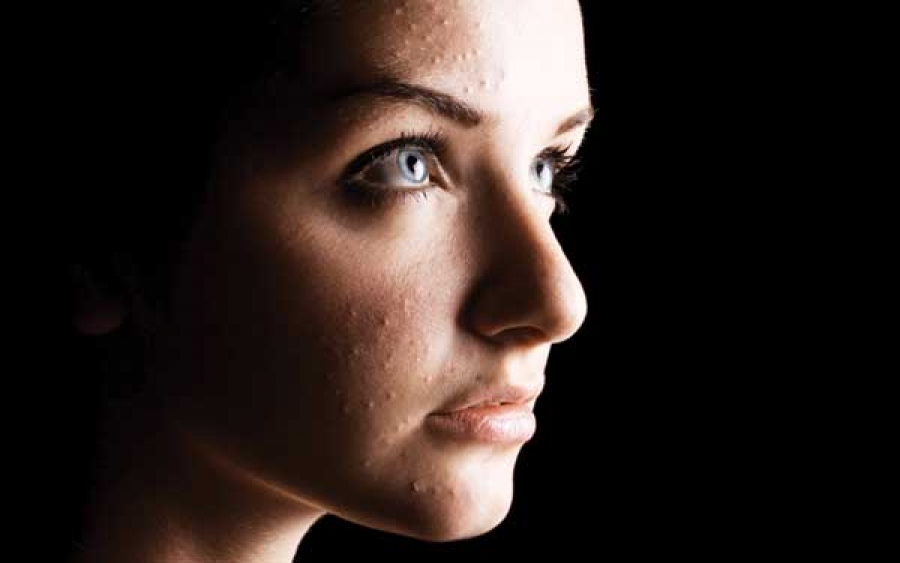 Skintervention 101: Acne Habits to Break and Prevent