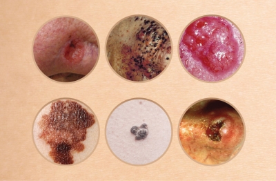 The Importance of Early Detection of Melanoma