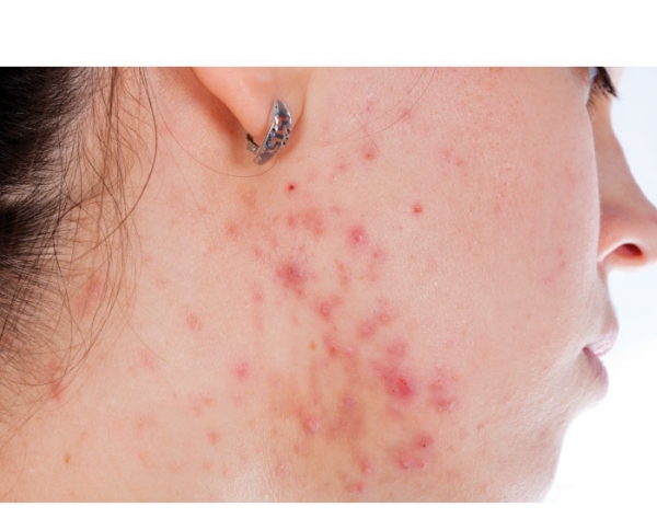 When Acne Leads to Skin Discoloration