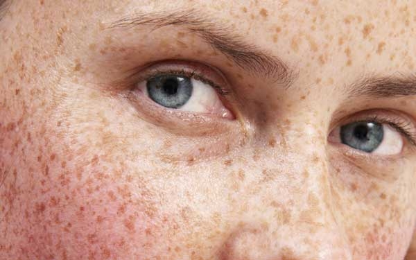 New Advances in Treating Hyperpigmentation