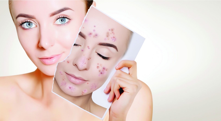 Adding Acne Services: 10 Tips for Success