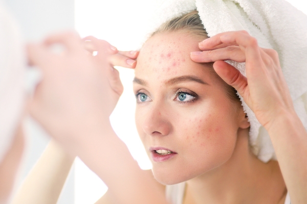 All Time High: A Look at the Increasing Occurrence of Adult Acne