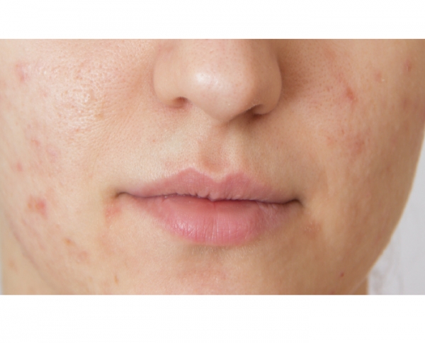 Clients will eventually outgrow acne.