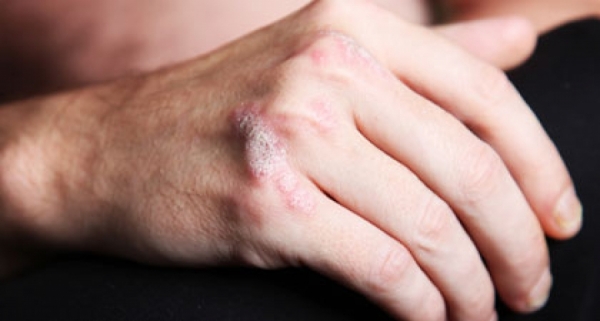 Psoriasis Patients Face Higher Than Average Death Risk After a Heart Attack