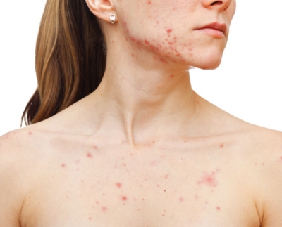 10 Things About...Body Acne