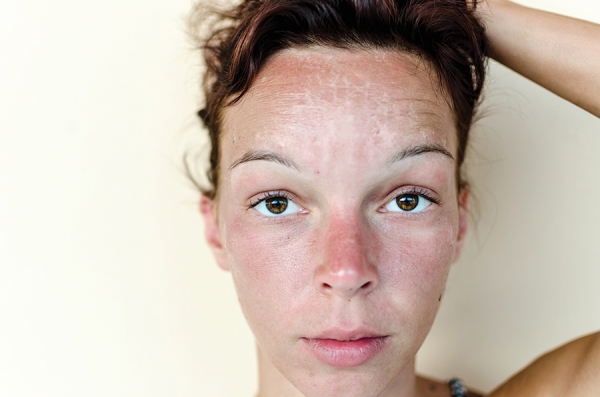 FACT OR FICTION: There is such a thing as  sunburnt DNA.