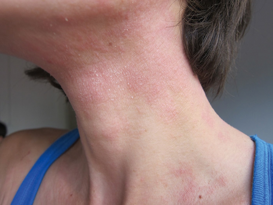 eczema on neck