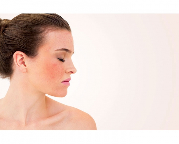 The Red Face of Rosacea Classifying and Treating Rosacea