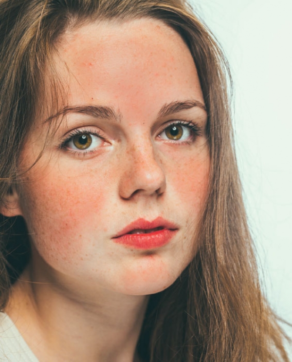 Rosacea Exposed: What They Don’t Teach You