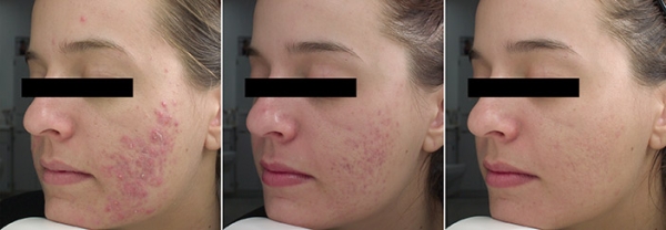 Reduce Acne Suffering:  The Use of Good Clinical Photographs to Improve Treatment Compliance