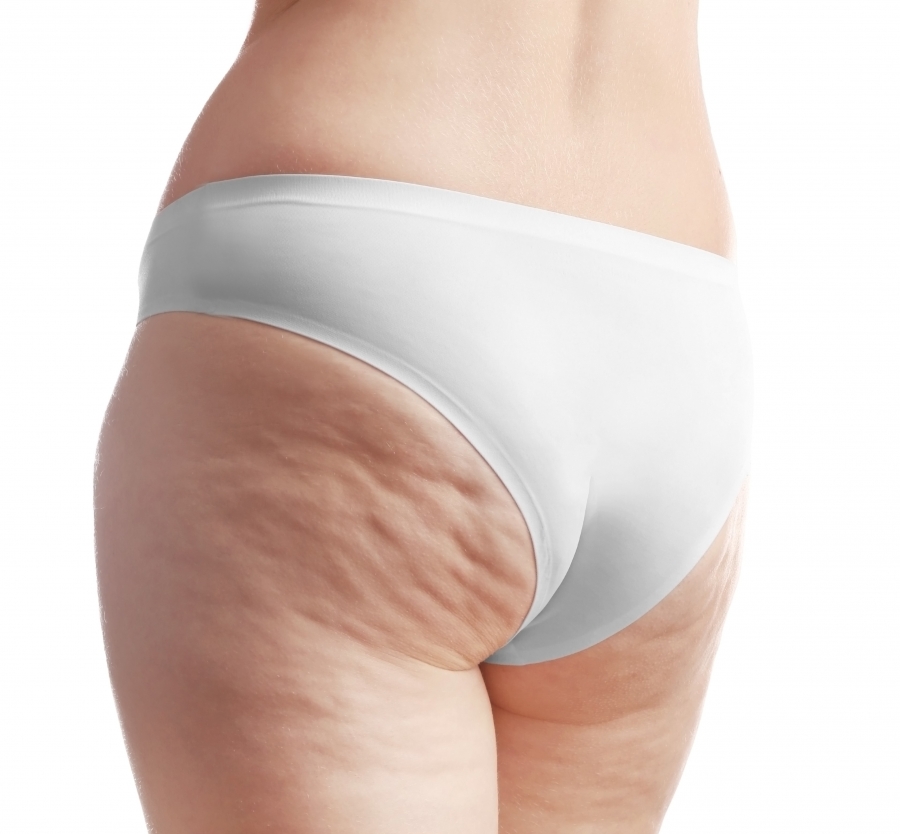Fat or Fiction? Debunking the Myths of Cellulite