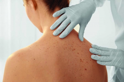 Skin Cancer Doesn’t Discriminate: Finding the Best Treatment Options for ...