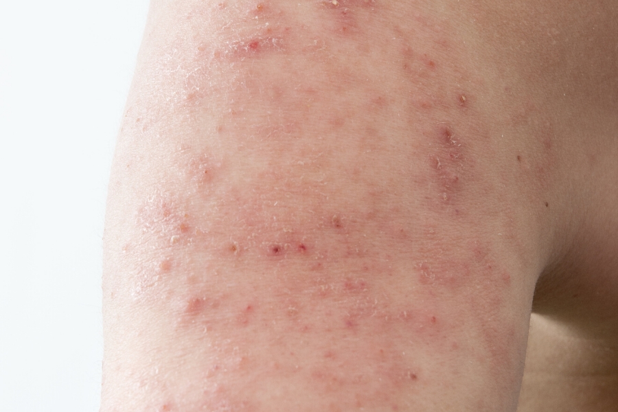 Varieties of Dermatitis