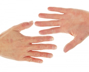 Chronic Dry Hands