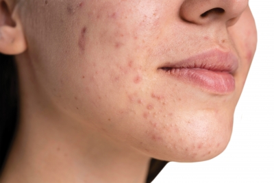 Acne Essentials: Dos & Don’ts for Problem Skin