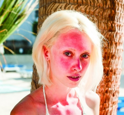 Fact or Fiction: Sun exposure makes rosacea worse.
